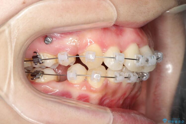 重度の前歯のガタガタ　ワイヤーによる矯正治療 治療途中画像