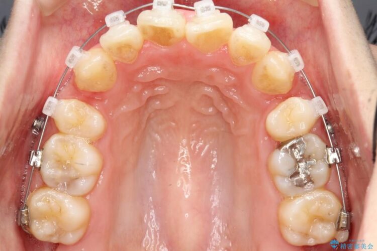 重度の前歯のガタガタ　ワイヤーによる矯正治療 治療途中画像