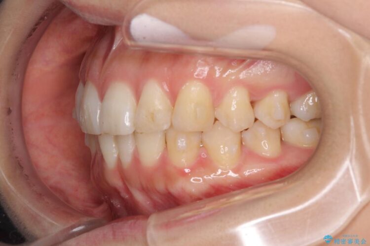 インビザラインで周りに知られず歯の矯正を 治療途中画像