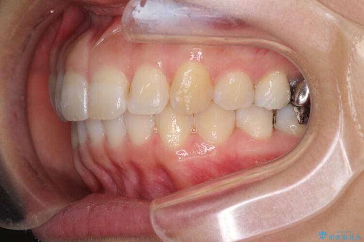 インビザラインで目立たず・歯を抜かずに八重歯の矯正 治療後画像