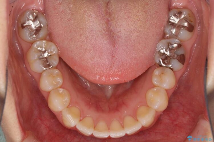 インビザラインで目立たず・歯を抜かずに八重歯の矯正 治療後画像