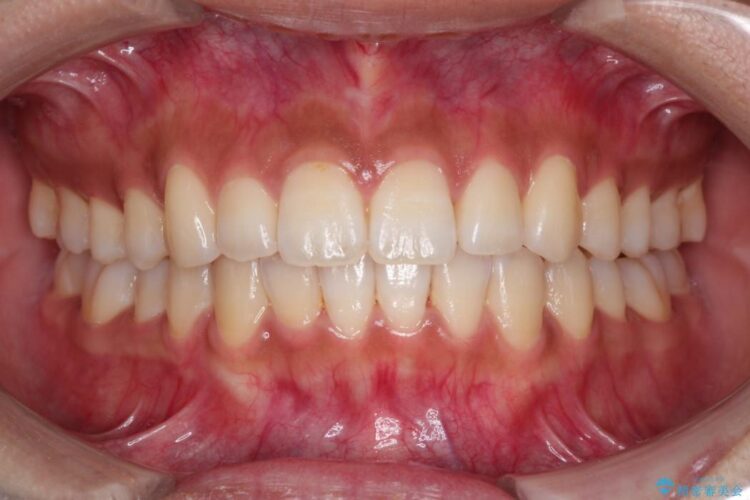 インビザラインで前歯の並びを改善 治療後画像
