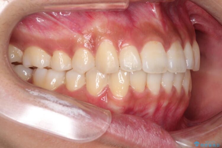 インビザラインで前歯の並びを改善 治療後画像