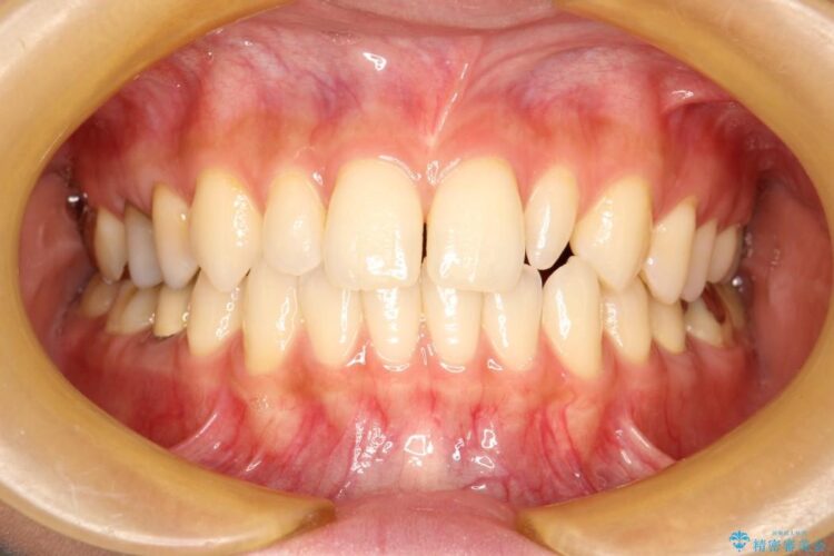 正中のすき間の部分矯正・矮小歯のオールセラミックによる治療 ビフォー