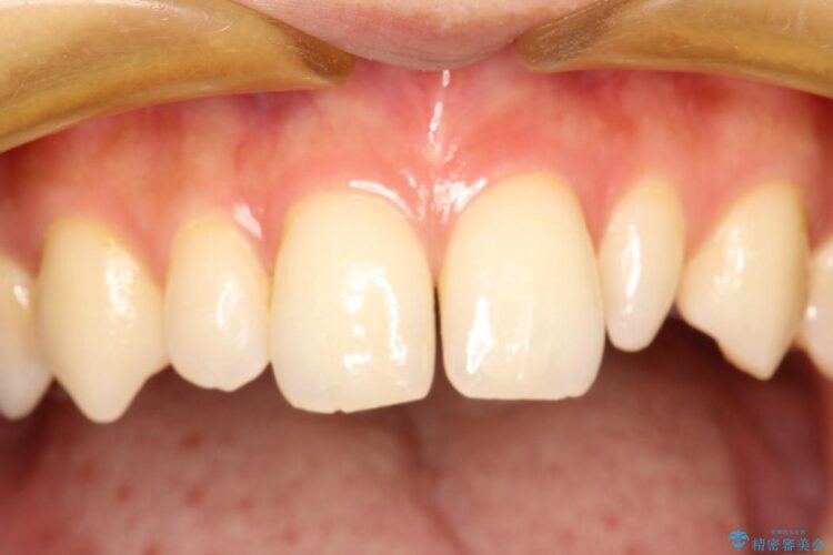 正中のすき間の部分矯正・矮小歯のオールセラミックによる治療 治療前画像