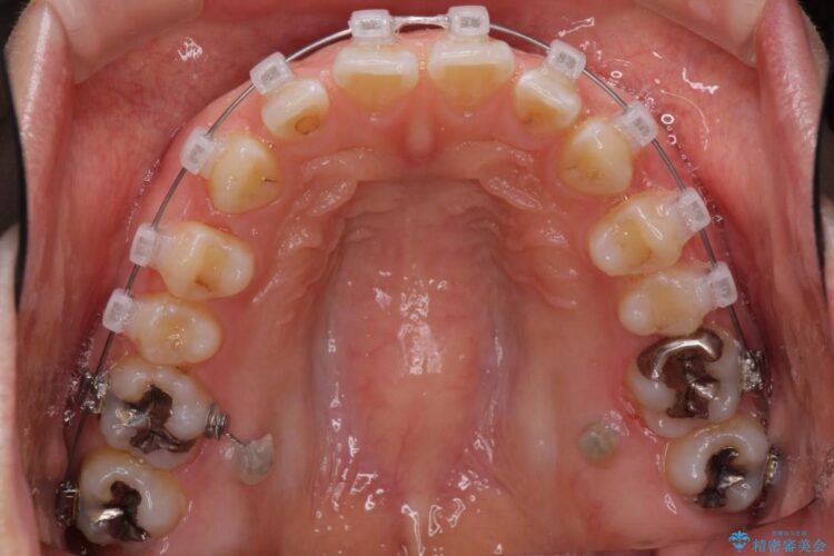 すきっ歯　ワイヤー矯正による治療 治療途中画像