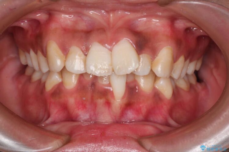前歯のガタガタ・八重歯治したい　ワイヤーによる矯正 ビフォー