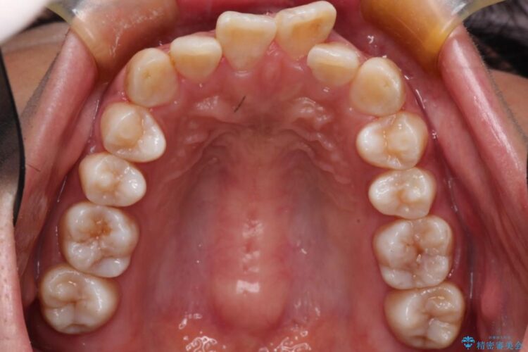 前歯のガタガタ・八重歯治したい　ワイヤーによる矯正 治療前画像
