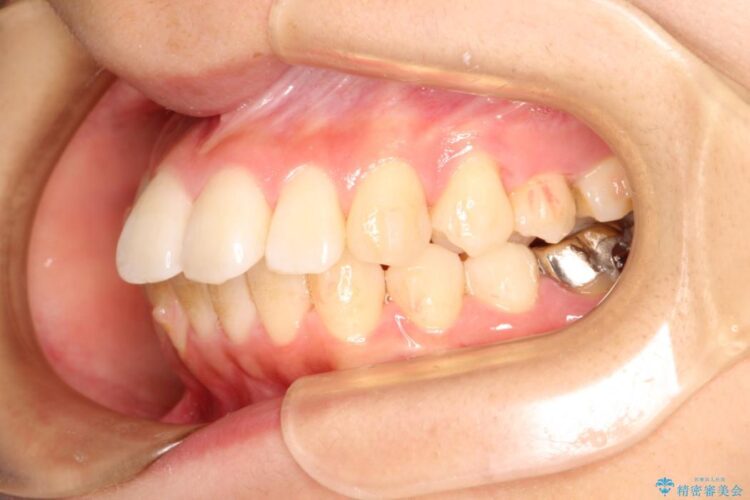 出っ歯を治したい　インビザラインによる目立たない矯正 治療途中画像