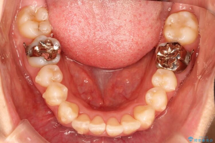 出っ歯を治したい　インビザラインによる目立たない矯正 治療途中画像