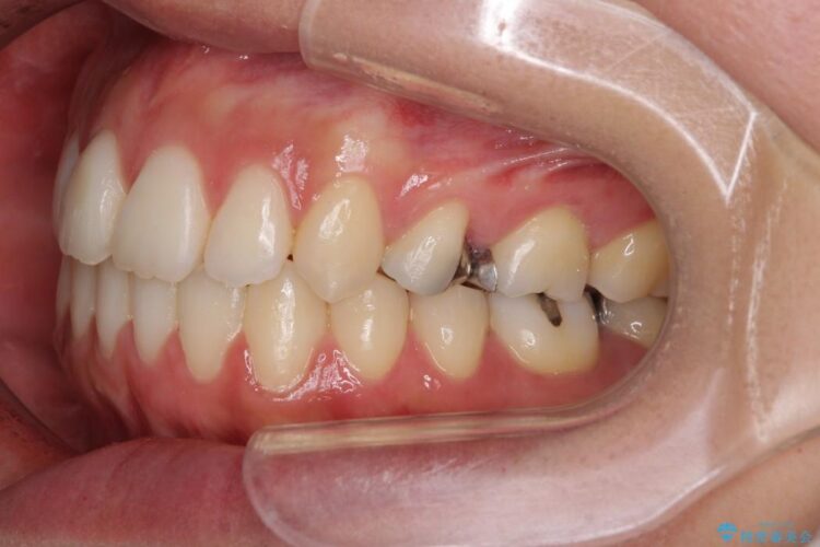 出っ歯のワイヤー矯正　抜歯による矯正 治療後画像