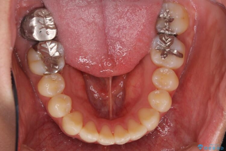 出っ歯のワイヤー矯正　抜歯による矯正 治療後画像