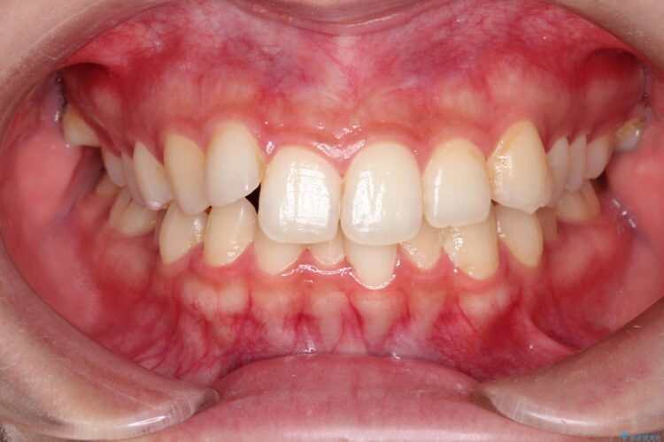 前歯のがたがた気になる　目立たないインビザラインによる矯正治療 ビフォー