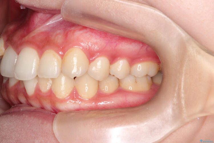 前歯のがたがた気になる　目立たないインビザラインによる矯正治療 治療前画像