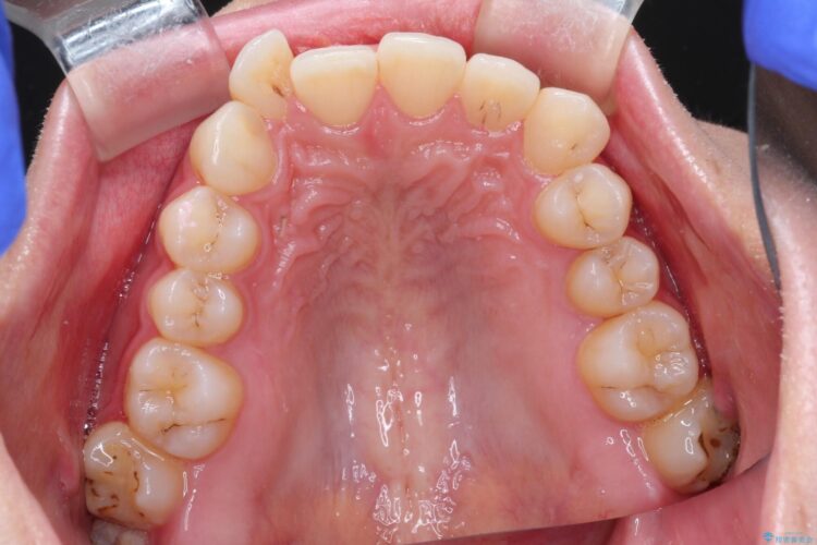 前歯のがたがた気になる　目立たないインビザラインによる矯正治療 治療前画像