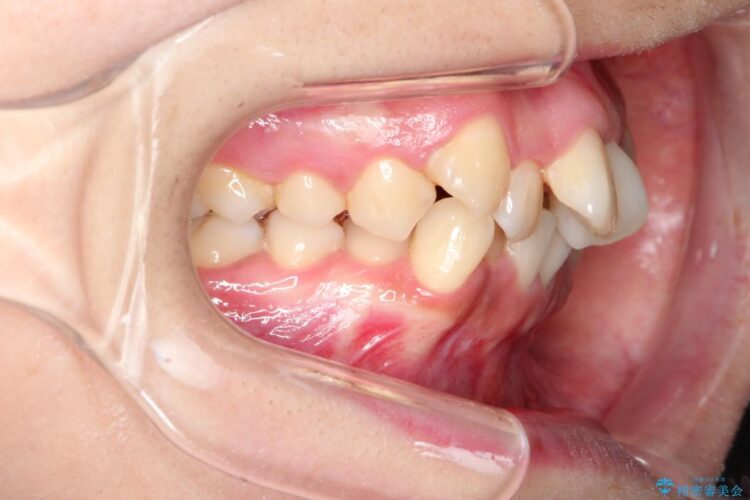 重度の前歯のガタガタ　ワイヤーによる矯正治療 治療前画像