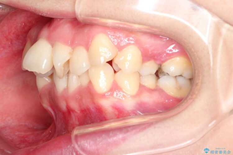 重度の前歯のガタガタ　ワイヤーによる矯正治療 治療前画像