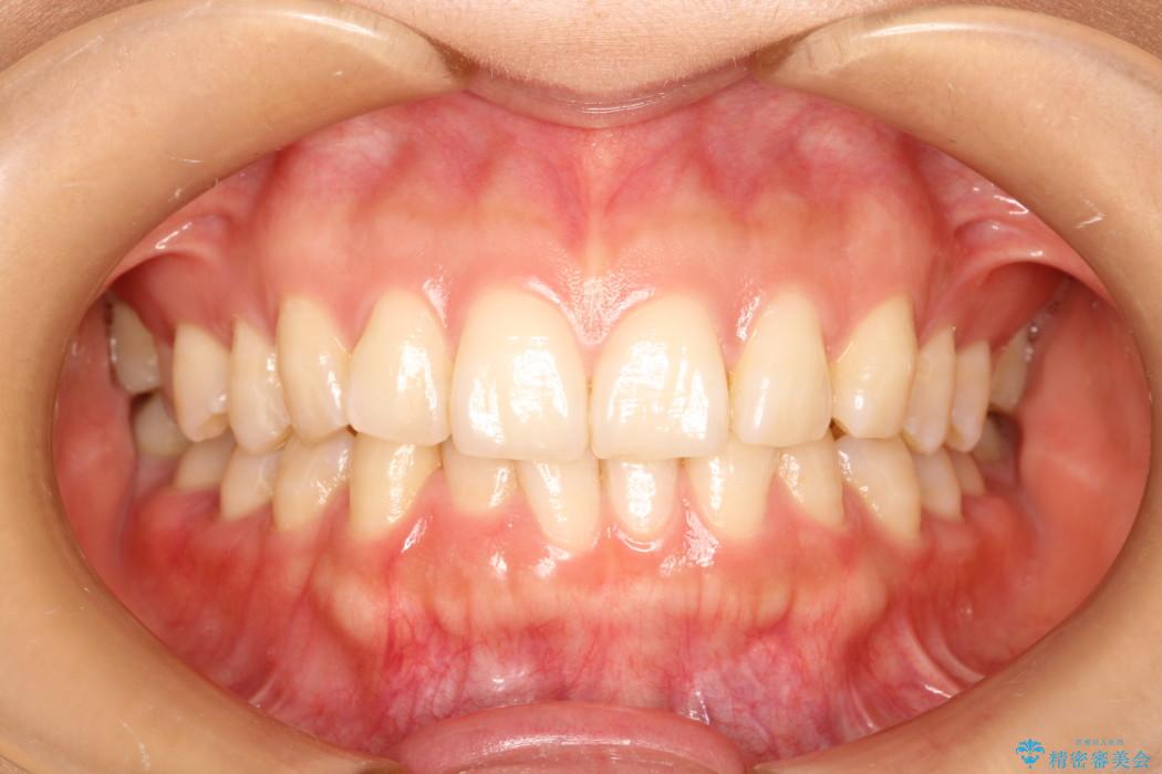 インビザラインで周りに知られず歯の矯正を 治療前