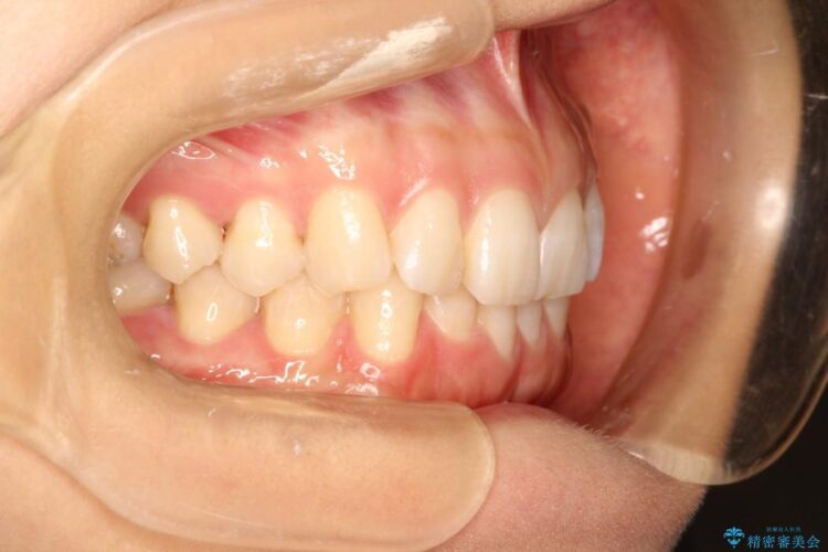 インビザラインで周りに知られず歯の矯正を 治療前画像