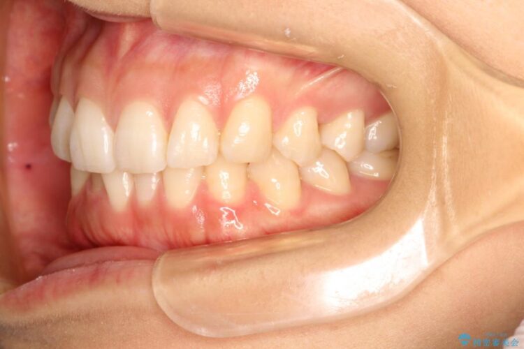 インビザラインで周りに知られず歯の矯正を 治療前画像