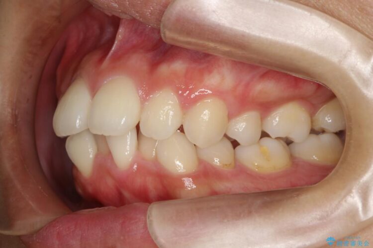 歯を抜かないでガタガタをなおす　裏側矯正 治療前画像