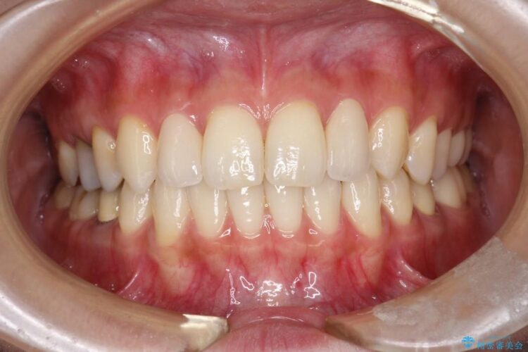 正中のすき間の部分矯正・矮小歯のオールセラミックによる治療 アフター