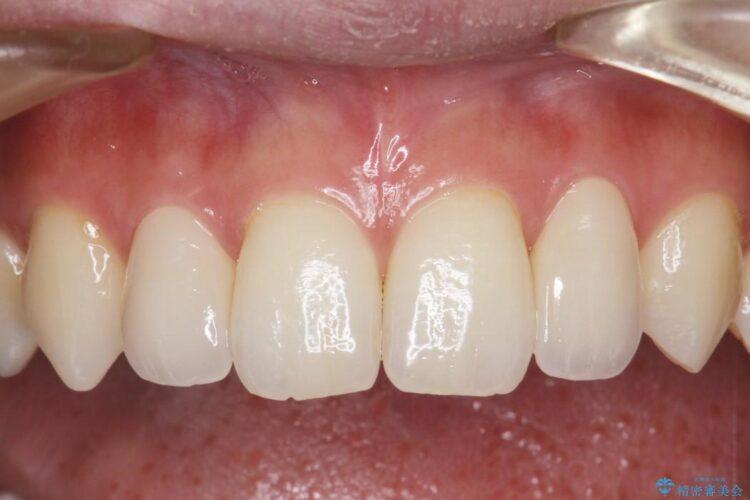 正中のすき間の部分矯正・矮小歯のオールセラミックによる治療 治療後画像