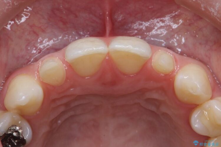 正中のすき間の部分矯正・矮小歯のオールセラミックによる治療 治療途中画像