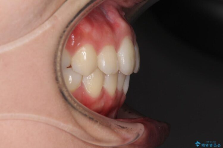 歯を抜かないでガタガタをなおす　裏側矯正 治療後画像