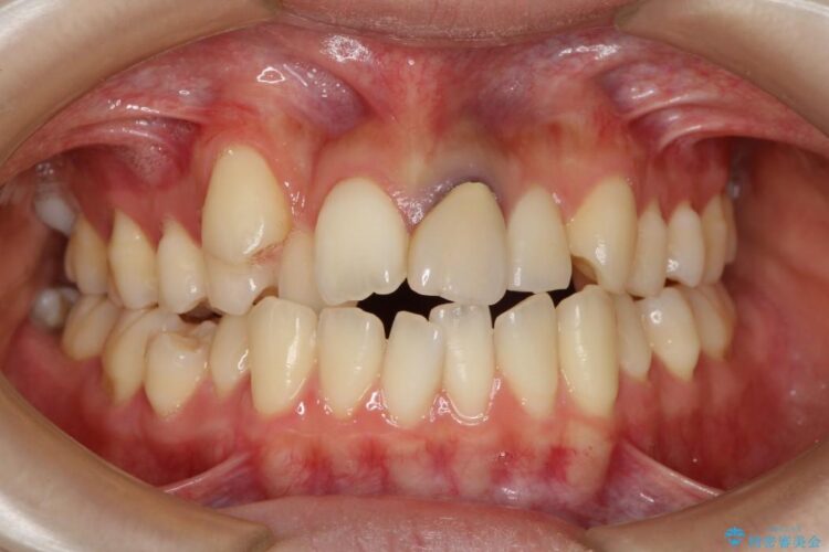 20代女性のワイヤー装置による八重歯の矯正治療 治療前画像