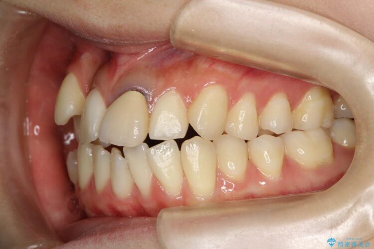 20代女性のワイヤー装置による八重歯の矯正治療 治療前画像