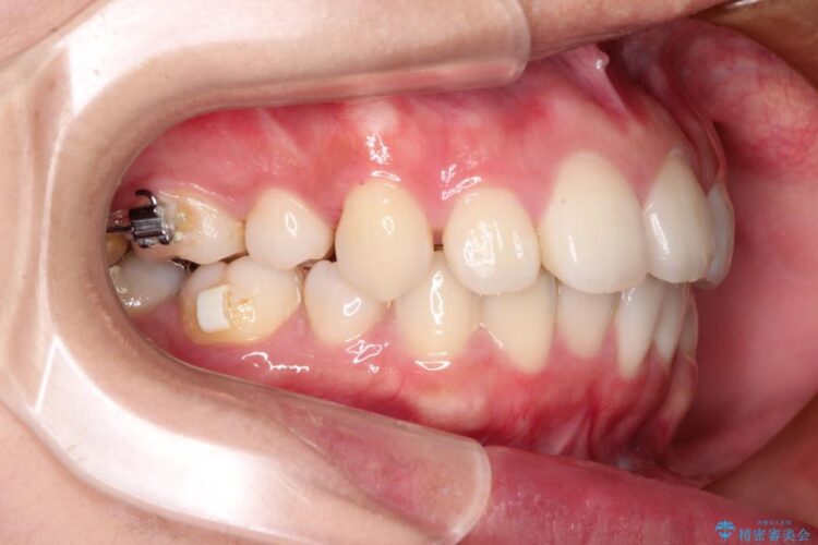 歯を抜かないでガタガタをなおす　裏側矯正 治療途中画像