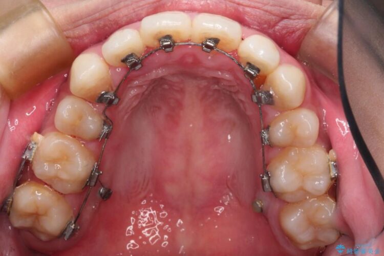 歯を抜かないでガタガタをなおす　裏側矯正 治療途中画像