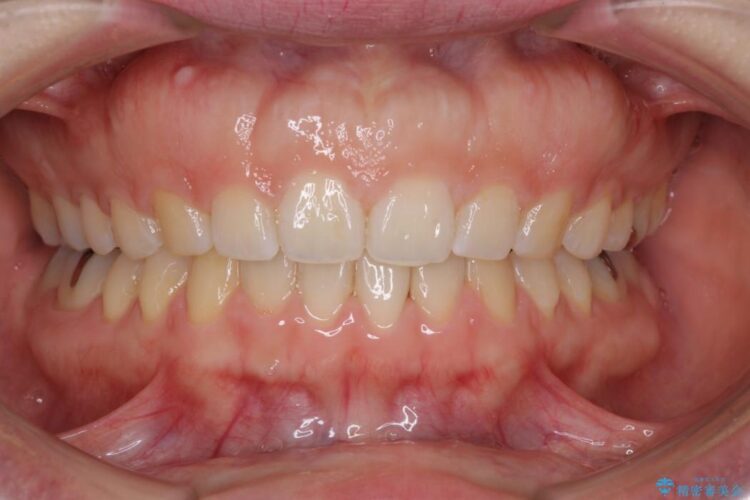 すきっ歯　ワイヤー矯正による治療 治療後画像