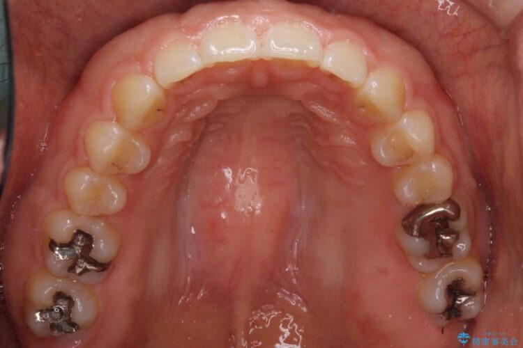 すきっ歯　ワイヤー矯正による治療 治療後画像