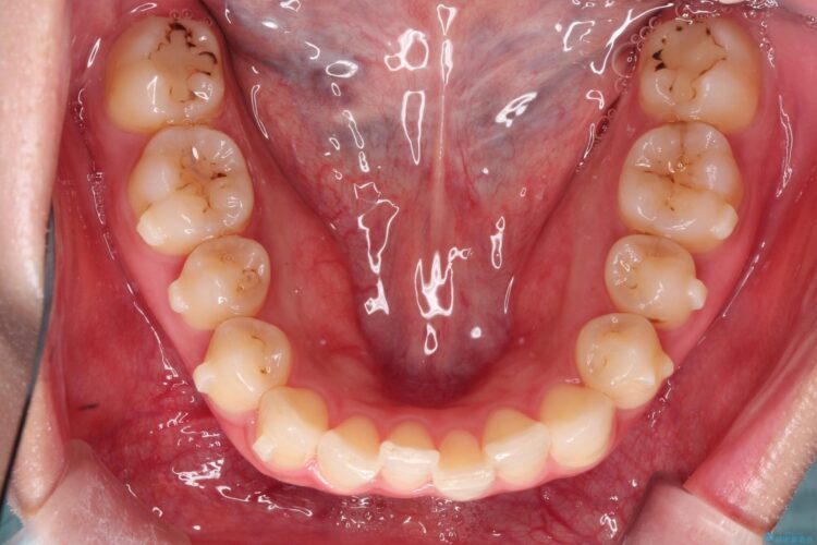 前歯のがたがた気になる　目立たないインビザラインによる矯正治療 治療途中画像