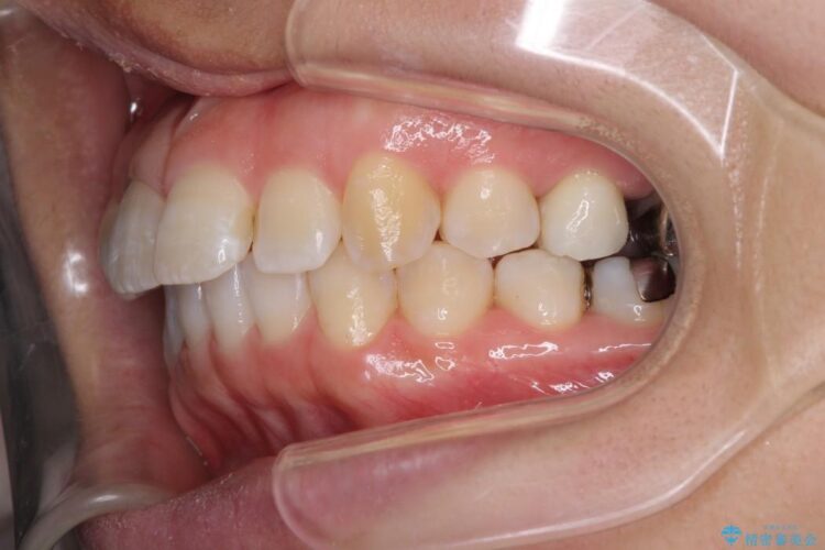 インビザラインで目立たず・歯を抜かずに八重歯の矯正 治療途中画像