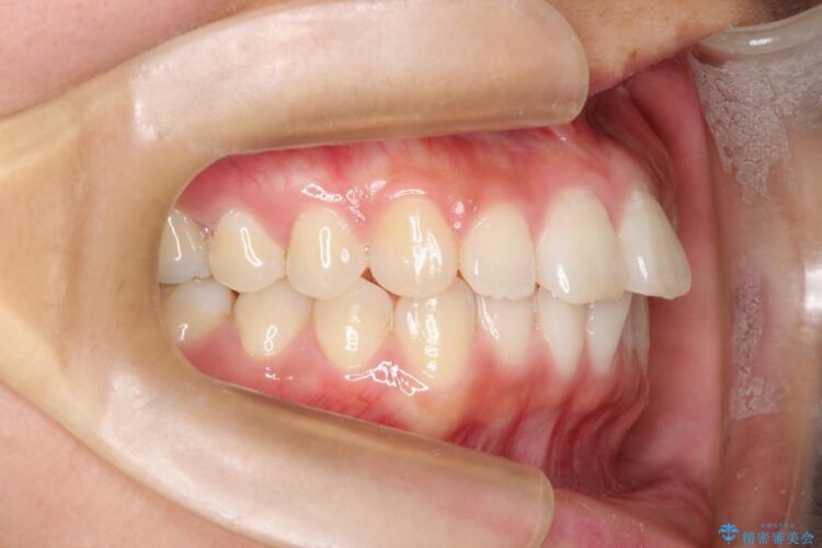 インビザラインで前歯のデコボコを目立たず矯正 治療前画像