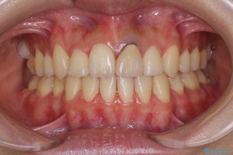 20代女性のワイヤー装置による八重歯の矯正治療 治療後画像