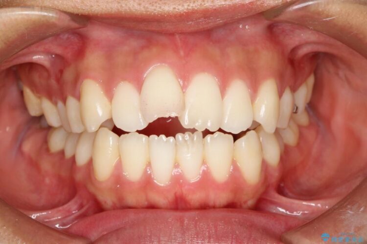 出っ歯のワイヤー矯正　抜歯による矯正 ビフォー