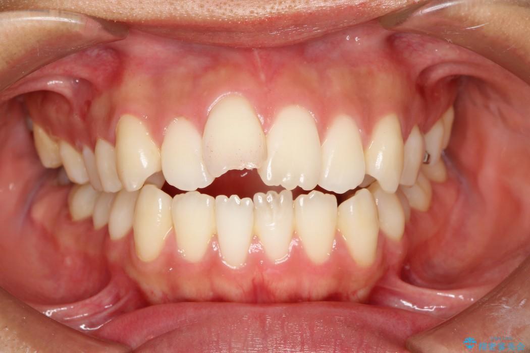出っ歯のワイヤー矯正　抜歯による矯正 治療前