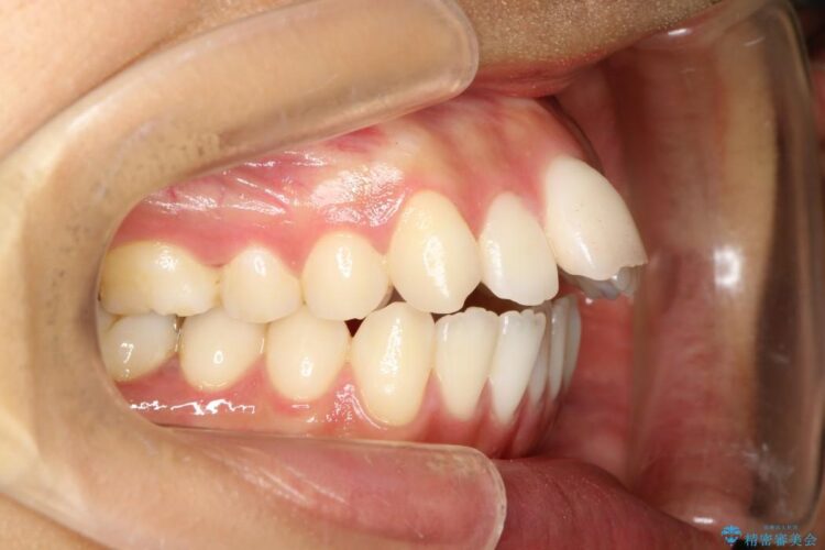 出っ歯のワイヤー矯正　抜歯による矯正 治療前画像