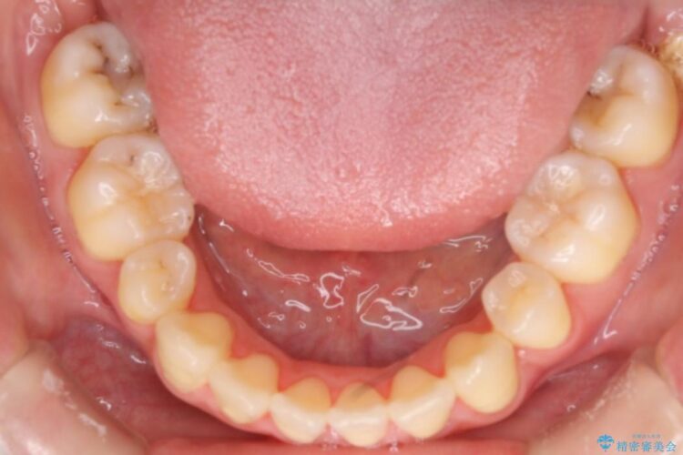 20代女性のワイヤー装置による八重歯の矯正治療 治療後画像