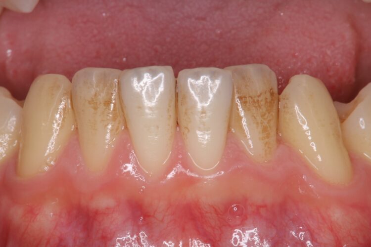 1時間で歯の表面をツルツルに 治療前画像