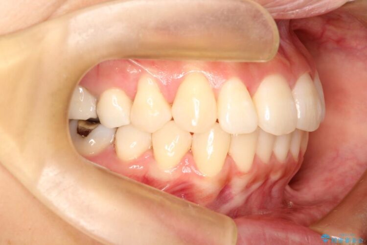 出っ歯を治したい　インビザラインによる目立たない矯正 治療後画像