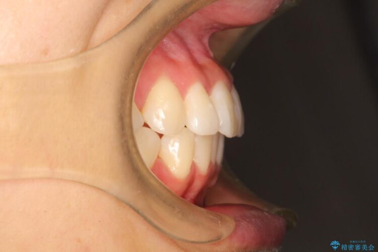 出っ歯を治したい　インビザラインによる目立たない矯正 治療後画像
