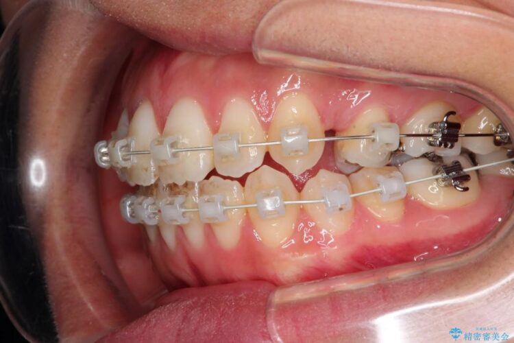 出っ歯のワイヤー矯正　抜歯による矯正 治療途中画像