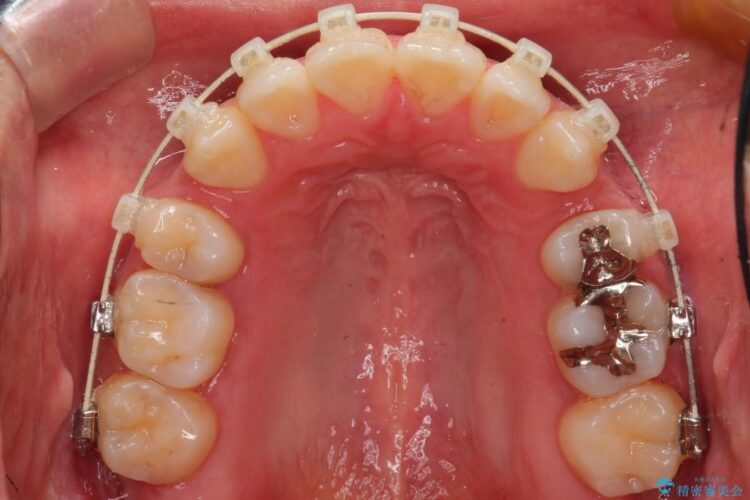 出っ歯のワイヤー矯正　抜歯による矯正 治療途中画像