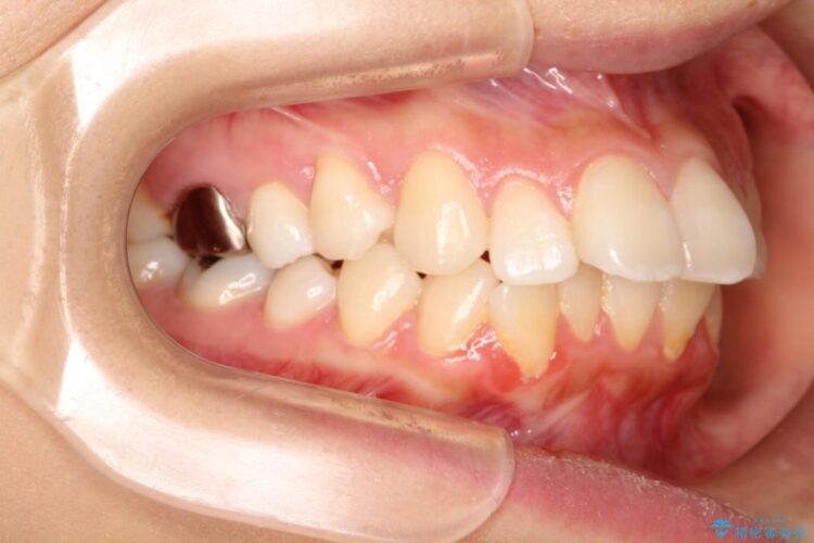 出っ歯を治したい　インビザラインによる目立たない矯正 治療前画像