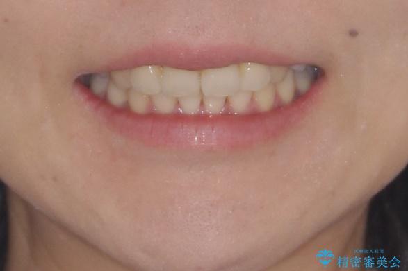 重度の前歯のガタガタ　ワイヤーによる矯正治療 治療後画像